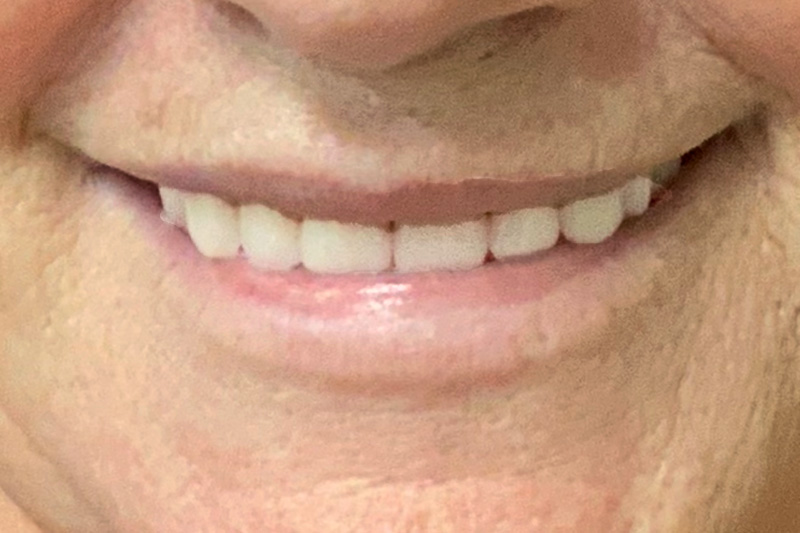 After image